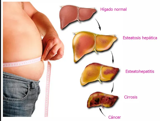Dietas genéricas vs hígado graso